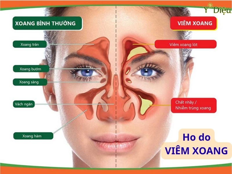 Viêm xoang mạn tính là nguyên nhân hàng đầu gây ho mãn tính